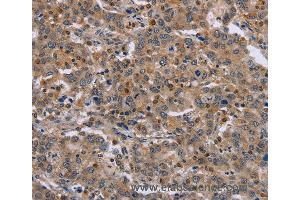 Immunohistochemistry of Human liver cancer using ETV7 Polyclonal Antibody at dilution of 1:30 (ETV7 anticorps)