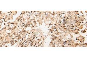 Immunohistochemistry of paraffin-embedded Human lung cancer tissue using URI1 Polyclonal Antibody at dilution of 1:45(x200)