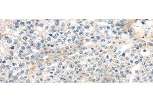 Immunohistochemistry of paraffin-embedded Human breast cancer tissue using TNFAIP8 Polyclonal Antibody at dilution 1:35