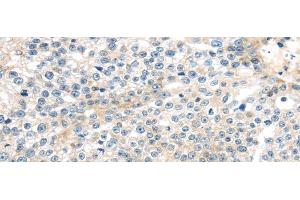 Immunohistochemistry of paraffin-embedded Human breast cancer tissue using TNFAIP8 Polyclonal Antibody at dilution 1:35 (TNFAIP8 anticorps)