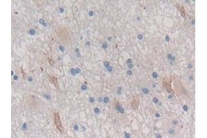 Detection of CTRB1 in Human Glioma Tissue using Polyclonal Antibody to Chymotrypsinogen B1 (CTRB1)