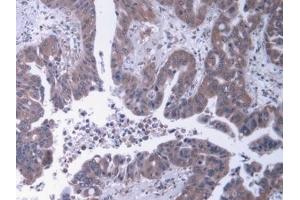 Detection of HSPG2 in Human Liver cancer Tissue using Polyclonal Antibody to Heparan Sulfate Proteoglycan 2 (HSPG2)