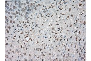 Immunohistochemical staining of paraffin-embedded Adenocarcinoma of colon tissue using anti-BUB1Bmouse monoclonal antibody. (BUB1B anticorps)