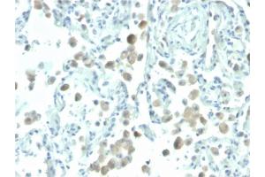 Formalin-fixed, paraffin-embedded human lung stained with Biotin-conjugated Mesothelin Mouse Monoclonal Antibody (MSLN/2131). (Mesothelin anticorps  (AA 273-407) (Biotin))