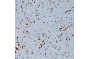 Immunohistochemistry of paraffin-embedded human gastric cancer using NASP Antibody.
