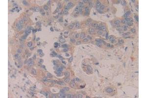 Detection of MAP2K6 in Human Breast cancer Tissue using Polyclonal Antibody to Mitogen Activated Protein Kinase Kinase 6 (MAP2K6)