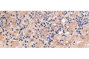 Immunohistochemistry of paraffin-embedded Human liver cancer tissue using INSM2 Polyclonal Antibody at dilution of 1:35(x200)
