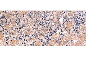 Immunohistochemistry of paraffin-embedded Human liver cancer tissue using INSM2 Polyclonal Antibody at dilution of 1:35(x200) (INSM2 anticorps)