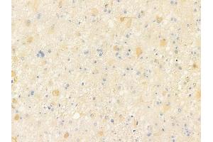ABIN6258145 and ABIN6273917 at 1/100 staining human astrocytoma by IHC-P. (S1PR5 anticorps  (C-Term))