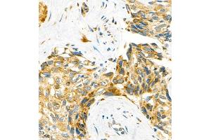 Immunohistochemistry of paraffin embedded human liver cancer using P4H (ABIN7074215) at dilution of 1:700 (400x lens) (HIF Prolyl Hydroxylase anticorps)