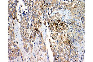 Anti-Hydroxysteroid(17-beta) Dehydrogenase 4 antibody, IHC(P) IHC(P): Human Lung Cancer Tissue