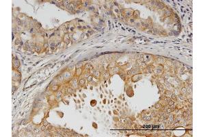 Immunoperoxidase of monoclonal antibody to ERBB2 on formalin-fixed paraffin-embedded human breast cancer.