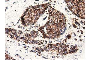 Immunohistochemical staining of paraffin-embedded Adenocarcinoma of Human breast tissue using anti-CLPP mouse monoclonal antibody. (CLPP anticorps)