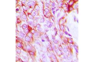Immunohistochemical analysis of EGFR staining in human breast cancer formalin fixed paraffin embedded tissue section. (EGFR anticorps  (C-Term))