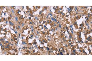 Immunohistochemistry of paraffin-embedded Human thyroid cancer using SERPINA1 Polyclonal Antibody at dilution of 1:30 (SERPINA1 anticorps)