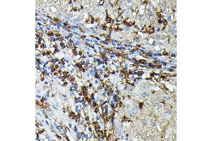 Immunohistochemistry of paraffin-embedded Human liver cancer using HLA-DPB1 antibody (ABIN7268370) at dilution of 1:100 (40x lens). (HLA-DPB1 anticorps)