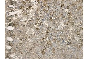 ABIN6255476 and ABIN6267169 at 1/100 staining human melanoma by IHC-P. (REPS1 anticorps  (pSer709))