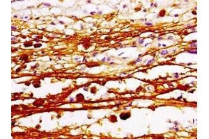 Immunohistochemistry of paraffin-embedded human melanoma using ABIN7160388 at dilution of 1:100 (MAZ anticorps  (AA 30-80))