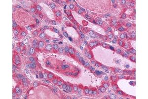 Anti-CD97 antibody IHC of human Thyroid, Follicular Carcinoma.