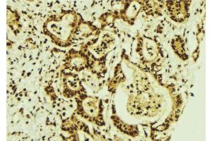 ABIN6274287 at 1/100 staining Human breast cancer tissue by IHC-P. (CEBPG anticorps  (Internal Region))