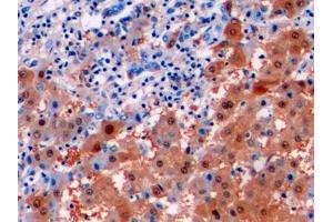 Detection of ARG in Human Liver cancer Tissue using Monoclonal Antibody to Arginase (ARG)