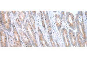 Immunohistochemistry of paraffin-embedded Human gastric cancer tissue using ATG16L1 Polyclonal Antibody at dilution of 1:40(x200) (ATG16L1 anticorps)