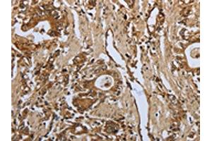 The image on the left is immunohistochemistry of paraffin-embedded Human gastic cancer tissue using ABIN7191969(PPARA Antibody) at dilution 1/30, on the right is treated with synthetic peptide. (PPARA anticorps)