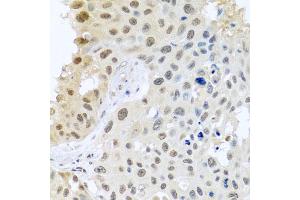 Immunohistochemistry of paraffin-embedded human lung cancer using DNAL1 antibody (ABIN5974658) at dilution of 1/100 (40x lens). (DNAL1 anticorps)