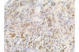 ABIN6256746 and ABIN6267646 at 1/100 staining human melanoma by IHC-P.
