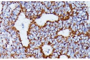 Immunohistochemistry of paraffin-embedded Human colon carcinoma using IDH3A Polyclonal Antibody at dilution of 1:100 (40x lens).