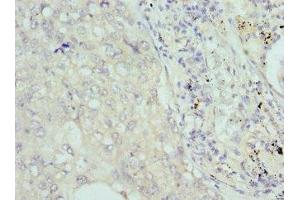 Immunohistochemistry of paraffin-embedded human lung cancer using ABIN7148039 at dilution of 1:100 (COCH anticorps  (AA 20-260))