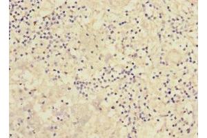 Immunohistochemistry of paraffin-embedded human liver cancer using ABIN7166553 at dilution of 1:100