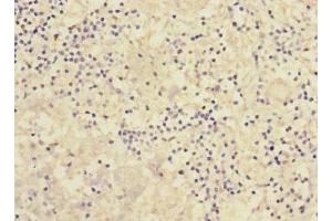 Immunohistochemistry of paraffin-embedded human liver cancer using ABIN7166553 at dilution of 1:100 (Protocadherin 1 anticorps  (AA 60-220))