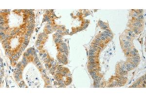 Immunohistochemistry of paraffin-embedded Human colon cancer tissue using SELENOM Polyclonal Antibody at dilution 1:50