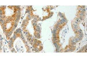 Immunohistochemistry of paraffin-embedded Human colon cancer tissue using SELENOM Polyclonal Antibody at dilution 1:50 (SELM anticorps)