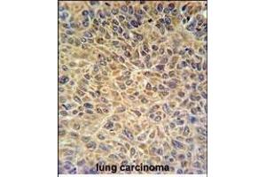 EXOC3L2 Antibody (N-term) (ABIN651216 and ABIN2840135) IHC analysis in formalin fixed and paraffin embedded human lung carcinoma followed by peroxidase conjugation of the secondary antibody and DAB staining. (EXOC3L2 anticorps  (N-Term))