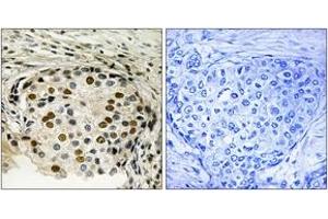 Immunohistochemistry analysis of paraffin-embedded human breast carcinoma, using OSR1 (Phospho-Thr185) Antibody.
