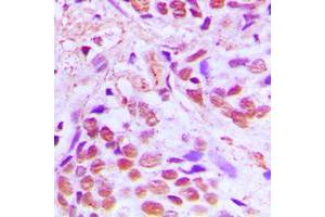 Immunohistochemical analysis of SRF staining in human breast cancer formalin fixed paraffin embedded tissue section. (SRF anticorps  (Center))