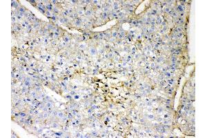 GNB1 was detected in paraffin-embedded sections of human liver cancer tissues using rabbit anti- GNB1 Antigen Affinity purified polyclonal antibody (Catalog # ) at 1 µg/mL.