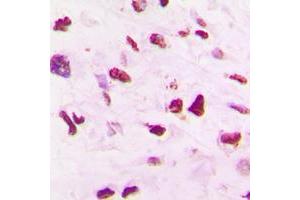 Immunohistochemical analysis of SKP2 staining in human lung cancer formalin fixed paraffin embedded tissue section. (SKP2 anticorps  (C-Term))
