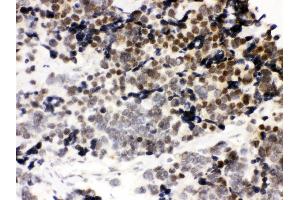 Anti-CTCF Picoband antibody, IHC(P) IHC(P): Human Lung Cancer Tissue (CTCF anticorps  (AA 521-727))