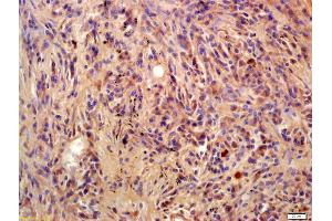 Formalin-fixed and paraffin embedded human lung carcinoma labeled with Anti-Phospho-BLNK(Tyr96) Polyclonal Antibody, Unconjugated (ABIN683458) at 1:200 followed by conjugation to the secondary antibody and DAB staining (B-Cell Linker anticorps  (pTyr96))