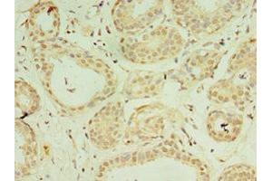 Immunohistochemistry of paraffin-embedded human breast cancer using ABIN7156912 at dilution of 1:100 (IL-37 anticorps  (AA 1-218))