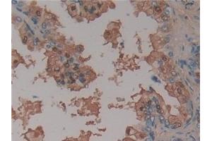Detection of AT in Human Prostate Tissue using Monoclonal Antibody to Antithrombin (AT)