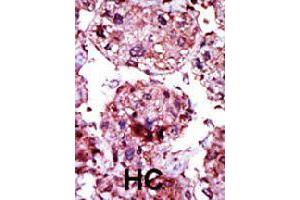 Formalin-fixed and paraffin-embedded human hepatocellular carcinoma tissue reacted with HK1 polyclonal antibody  , which was peroxidase-conjugated to the secondary antibody, followed by AEC staining. (Hexokinase 1 anticorps  (N-Term))