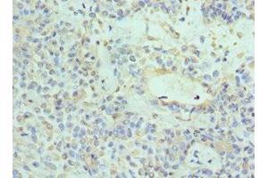 Immunohistochemistry of paraffin-embedded human breast cancer using ABIN7161741 at dilution of 1:100