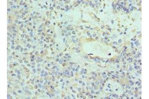 Immunohistochemistry of paraffin-embedded human breast cancer using ABIN7161741 at dilution of 1:100 (NTRK3 anticorps  (AA 40-300))