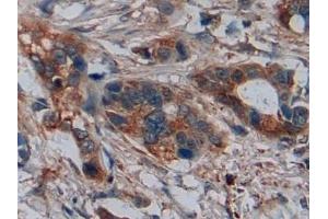 Detection of DISC1 in Human Pancreatic cancer Tissue using Polyclonal Antibody to Disrupted In Schizophrenia 1 (DISC1) (DISC1 anticorps  (AA 102-261))