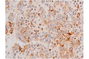 ABIN6267525 at 1/200 staining Human liver cancer tissue sections by IHC-P.