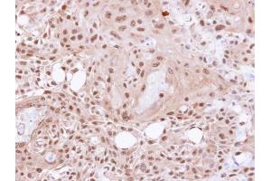 IHC-P Image Immunohistochemical analysis of paraffin-embedded Ca922 xenograft, using VCP(p97), antibody at 1:500 dilution.